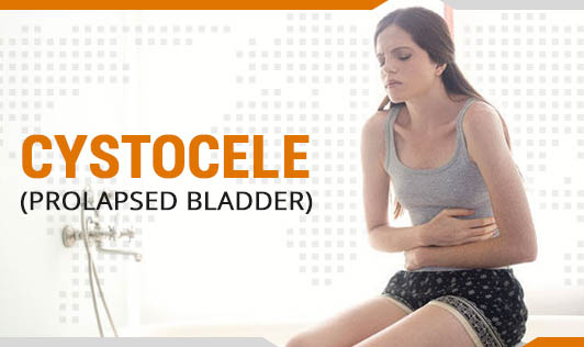 Cystocele Prolapsed Bladder The Wellness Corner