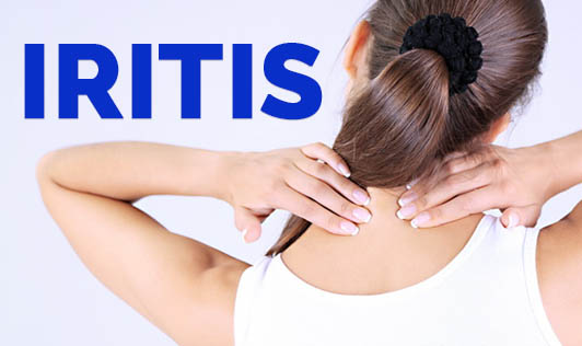 Iritis