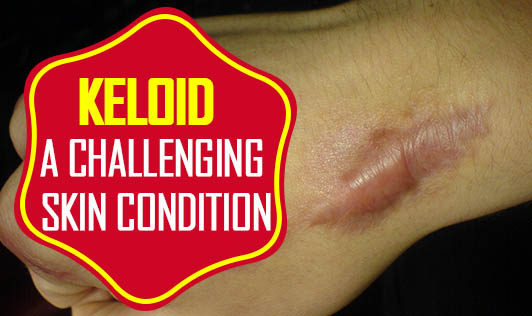 Keloid- A challenging skin condition