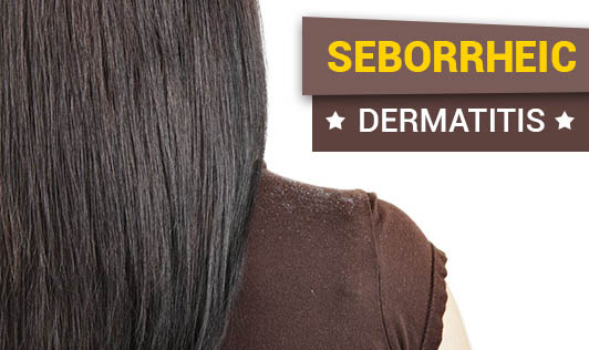 Seborrheic Dermatitis