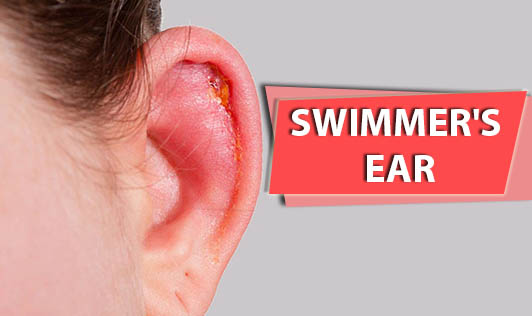 Swimmer's Ear Causes, Symptoms, Natural Treatments Axe, 50% OFF