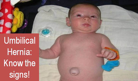 Umbilical Hernia: Know the signs!
