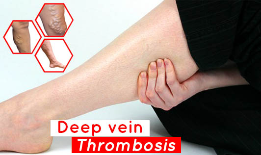 Deep vein thrombosis