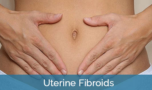 Uterine Fibroids
